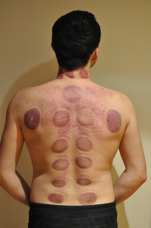 massage cupping
